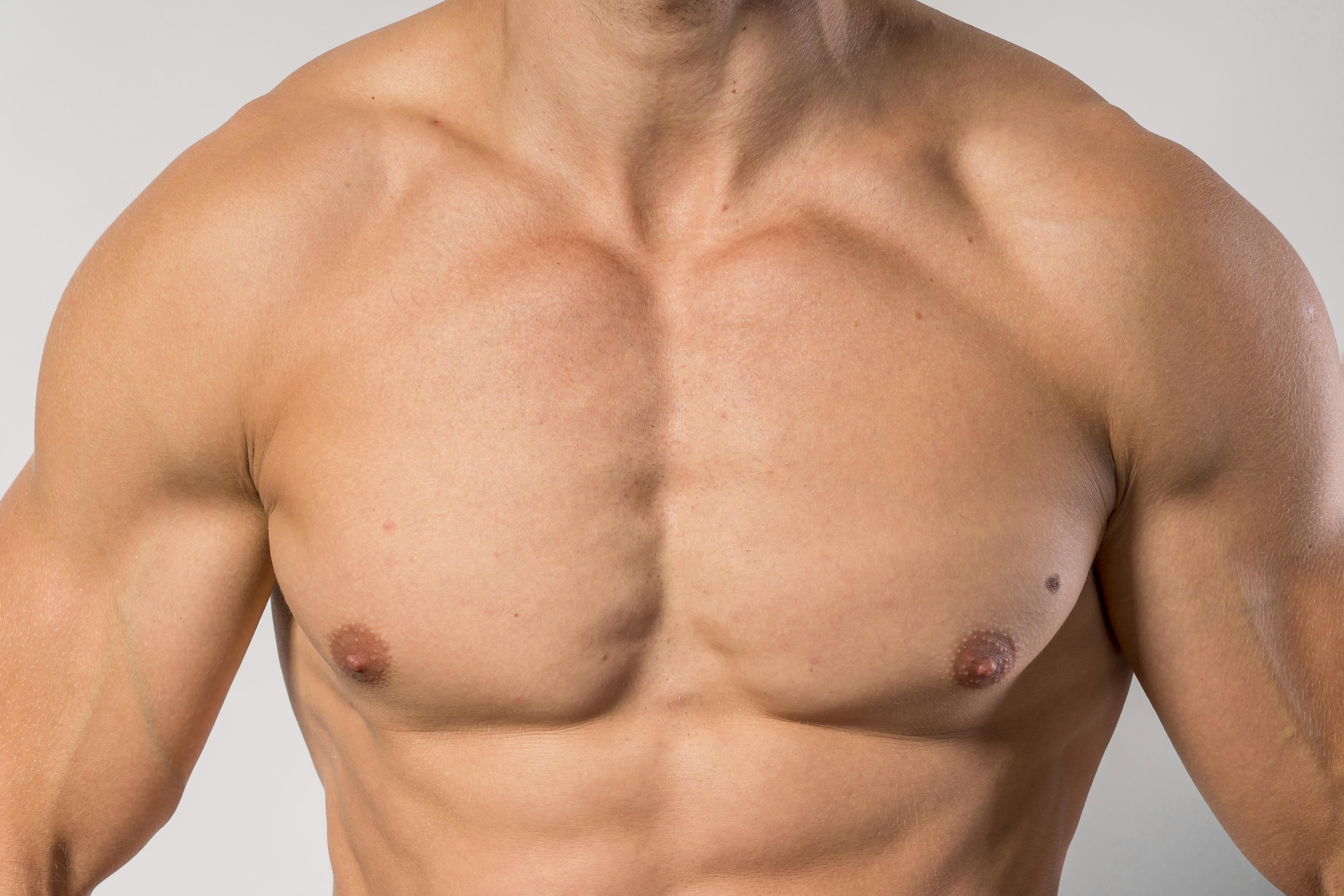 Gynecomastia Treatment: Can Raloxifene Be a Success?